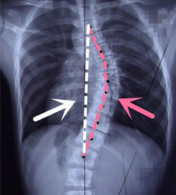 脊柱側(cè)彎后身高會(huì)變短嗎？