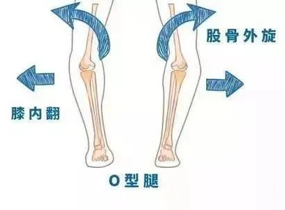 孩子“O”型腿怎么辦？