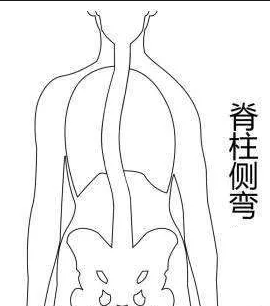 脊柱側(cè)彎康復(fù)訓(xùn)練主要從四個(gè)方面入手！