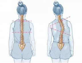 怕耽誤學(xué)習(xí)，脊柱側(cè)彎就不治療了嗎？